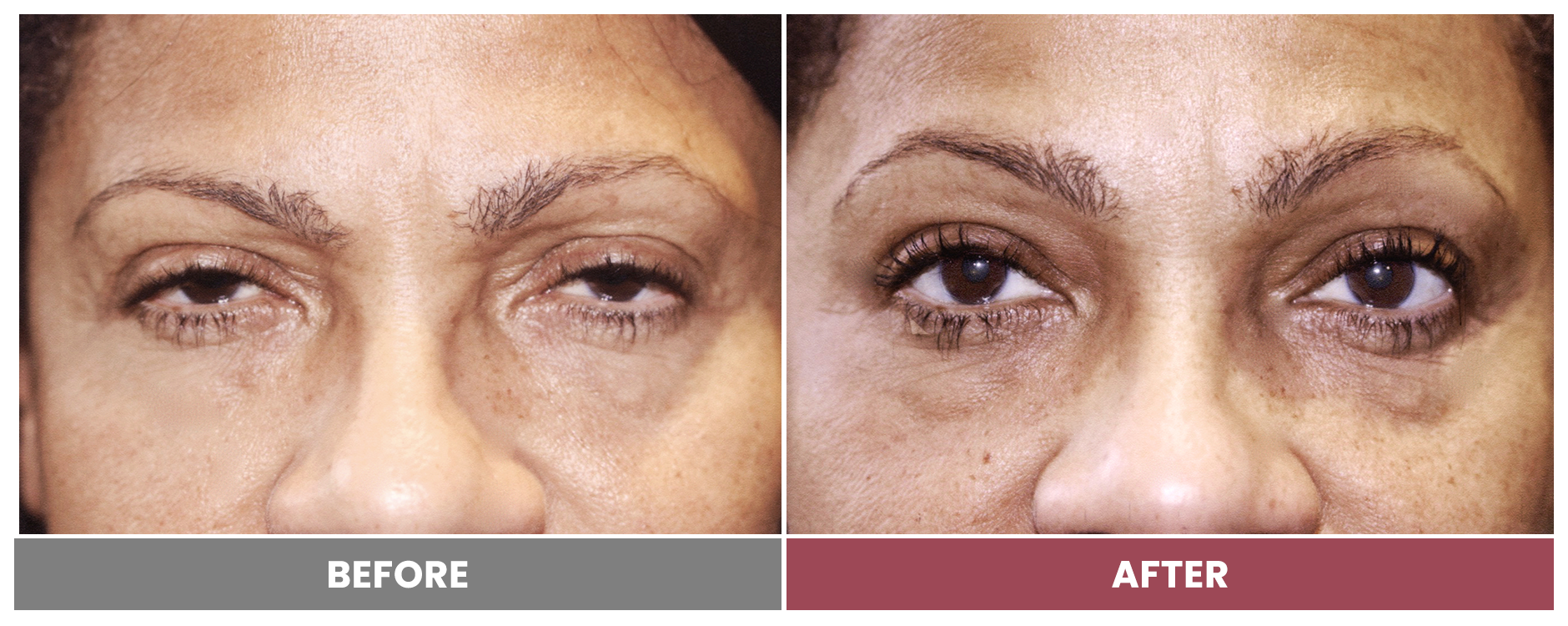 PTOSIS REPAIR - Case 35